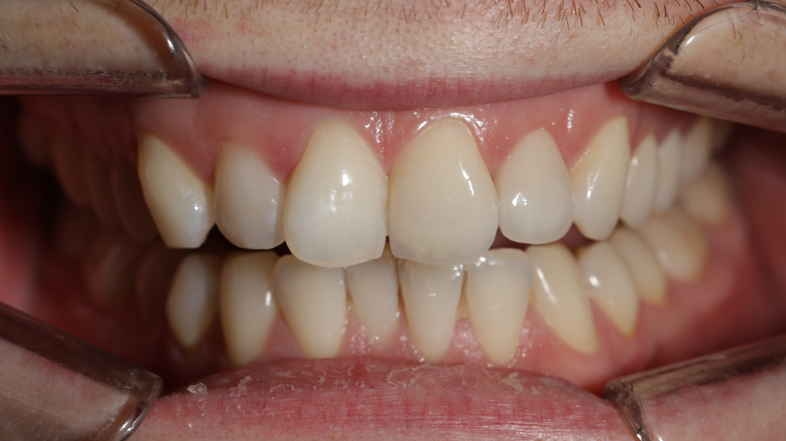 Natürlich schöne Frontzähne